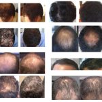 restore your hair growth with low level laser treatment